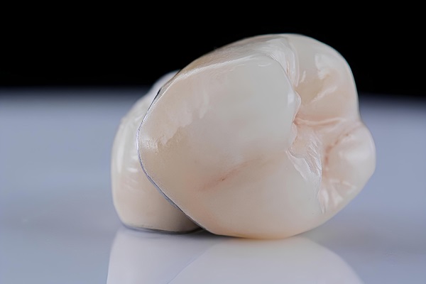 Metal Crowns Vs  Porcelain Dental Crowns