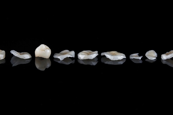 Dental Inlay Vs  Crown: When To Choose An Inlay, According To A Dentist