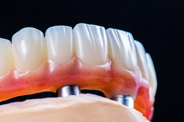 Common Questions About Implant Supported Dentures